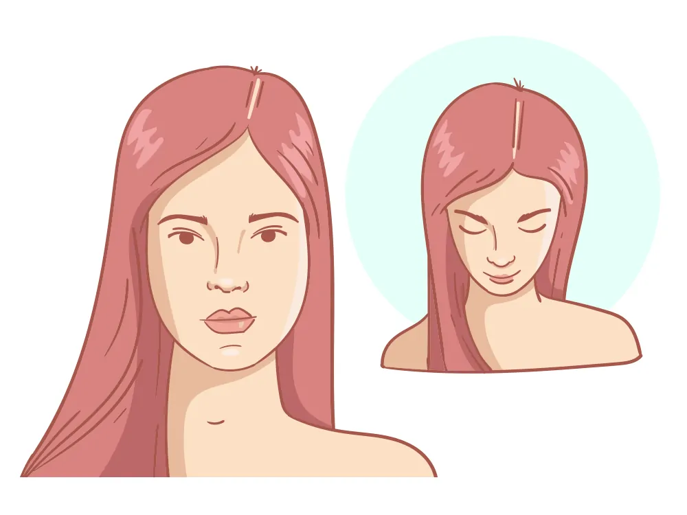 Recessione dell'attaccatura dei capelli + leggera corona