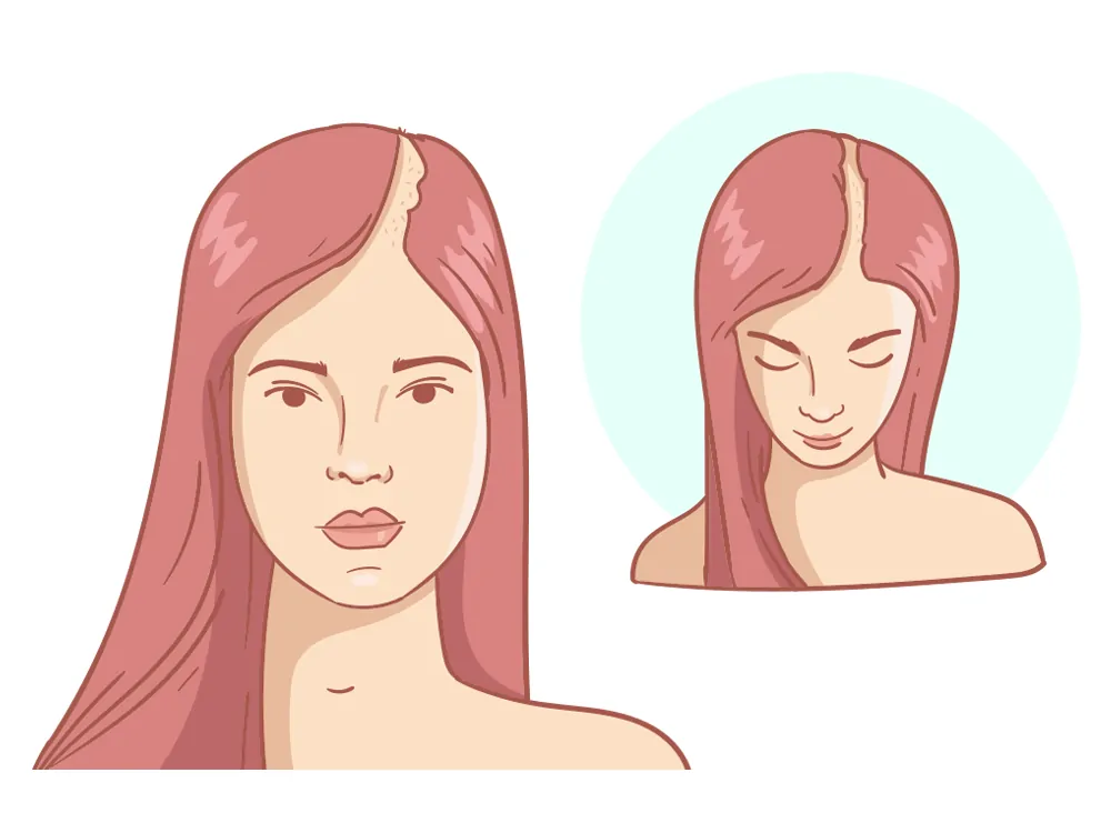 Recessione dell'attaccatura dei capelli Forte + Corona